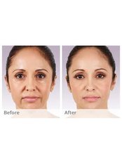 Dermal Fillers - The Cosmetic Clinic - King's Lynn