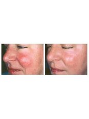Rosacea Treatment - The Cosmetic Clinic - King's Lynn