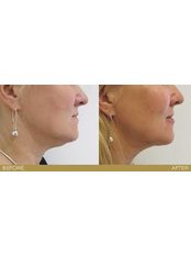 Silhouette Lift™ - The Cosmetic Clinic - King's Lynn