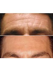 Treatment for Wrinkles - The Cosmetic Clinic - King's Lynn