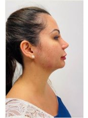Chin Augmentation - Maples Aesthetics Clinic