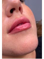 Lip Augmentation - Maples Aesthetics Clinic