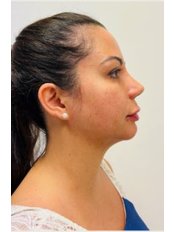Chin Augmentation - Maples Aesthetics Clinic