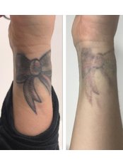 Tattoo Removal - Norwhich Face & Body Clinic