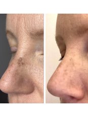 Pigmentation Treatment - Norwhich Face & Body Clinic