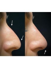 Non-Surgical Nose Job - Dr Aimee Moss