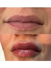 Lip Filler - Blush Medical Aesthetics