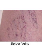 Spider Veins Treatment - Harrogate Aesthetics