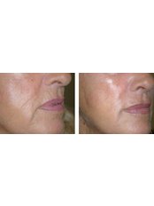 Dermal Fillers - Renaissance Health And Beauty