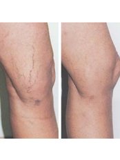 Sclerotherapy - Renaissance Health And Beauty