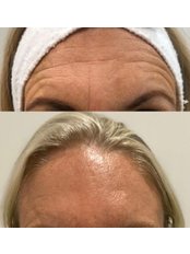 Treatment for Wrinkles - Spa 810