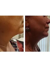 Fat Reduction Injections - Lets Face It Aesthetics York