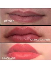 Lip Augmentation - Chaelis Clinic