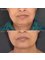 Indulgence Skin Laser and Beauty Clinic - Endymed - Jawline tightening 
