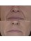 Indulgence Skin Laser and Beauty Clinic - Nasolabial fold treatment  