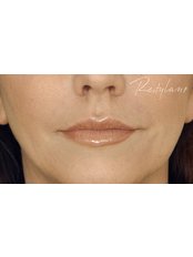 Lip Augmentation - Medical Cosmetics Ltd