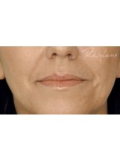 Lip Augmentation - Medical Cosmetics Ltd