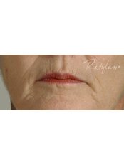 Lip Filler - Medical Cosmetics