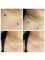 Pure Aesthetics Clinic - Skin Tag Removal 