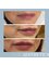 Pure Aesthetics Clinic - Lip Filler 
