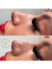 Non-Surgical Nose Job - Second Look Aesthetics