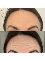 Anti Wrinkle Injections - Second Look Aesthetics