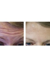 Treatment for Wrinkles - Beau-tx