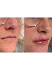 Lip Augmentation - CB Skin And Aesthetics