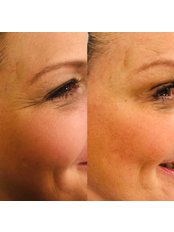 Treatment for Wrinkles - CB Skin And Aesthetics
