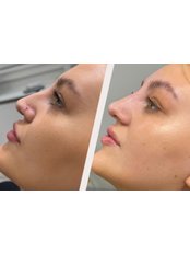 Non-Surgical Nose Job - Azure Aesthetics