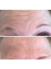 Treatment for Wrinkles - Beauty@Home