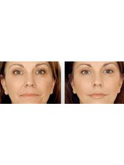 Dermal Fillers - The Beauty Spot Cosmetic Clinic