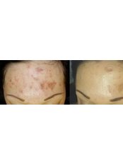Dermaroller™ - The Beauty Spot Cosmetic Clinic