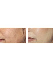 Chemical Peel - The Beauty Spot Cosmetic Clinic