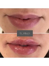 Lip Augmentation - Dr Alberti Aesthetic Treatments Oxford