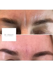Treatment for Wrinkles - Dr Alberti Aesthetic Treatments Oxford