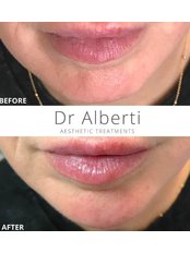Chin Augmentation - Dr Alberti Aesthetic Treatments Oxford