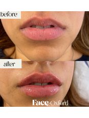 Lip Augmentation - FaceOxford