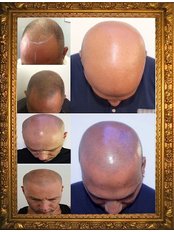 Men's Hair Restoration Scalp Tattoing Glasgow Scotland - Million Dollar Brows
