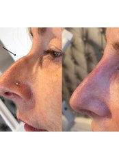 Non-Surgical Nose Job - Revitalise ME