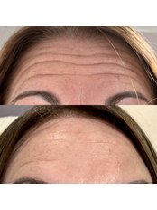 Treatment for Wrinkles - Revitalise ME