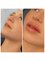 Aesthetica Skin Clinic - Weston-Super-Mare - Dermal Filler - Russian Lips 