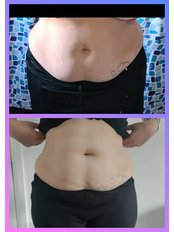 Fat Reduction Injections - Aesthetics Beauty With Sarah Lou