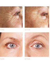 Treatment for Wrinkles - JR Beauty Aesthetics Clinic