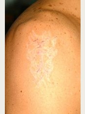 Liberation Tattoo Removal - 4 Hawthorne Avenue, Dunsville, Doncaster, DN7 4DW, 