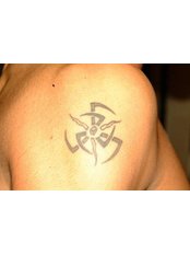 Tattoo Removal - Liberation Tattoo Removal