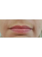 Lip Augmentation - Forever Young Aesthetics
