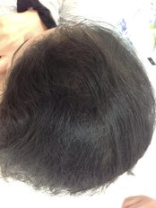 Hair Loss Treatment - Sheffield Aesthetics & Laser Clinic