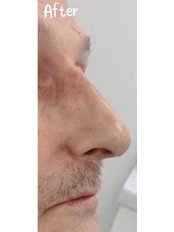 Non-Surgical Nose Job - Sheffield Aesthetics & Laser Clinic