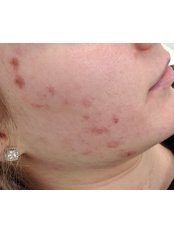 Acne Treatment combination Therapy - Sheffield Aesthetics & Laser Clinic